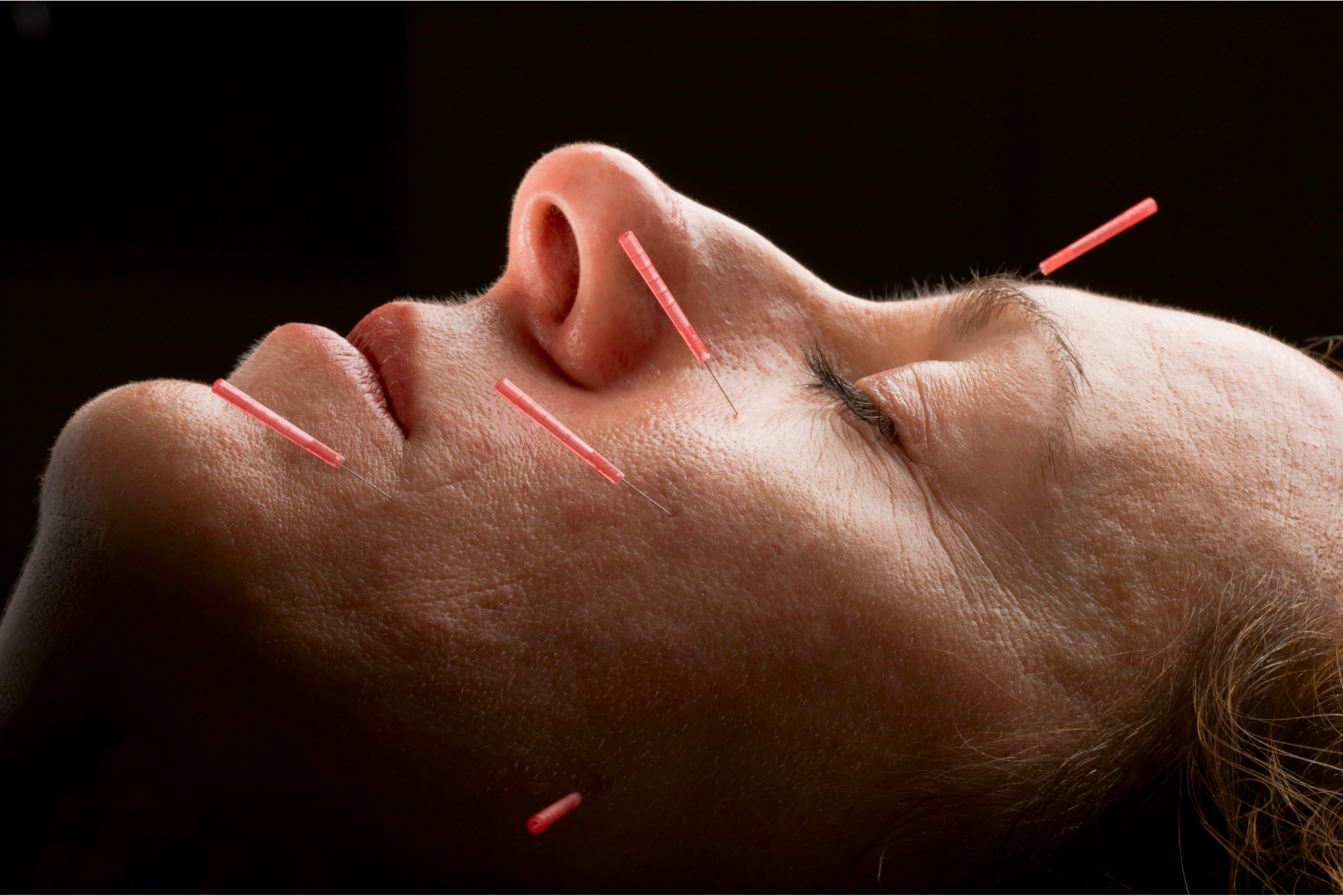 Acupuncture needle therapy